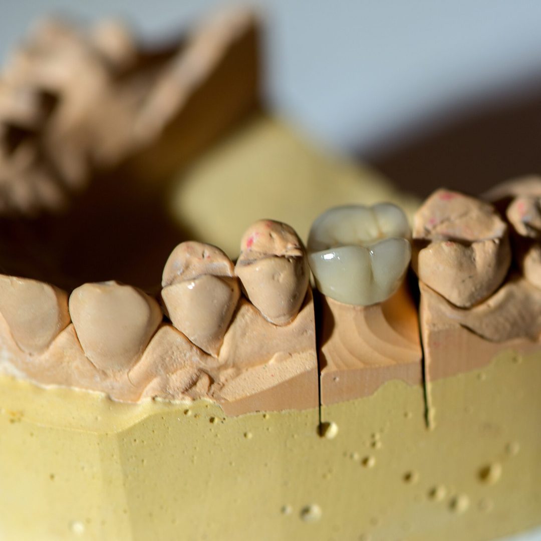 dental-prosthesis-on-white-background-2025-03-09-06-38-17-utc
