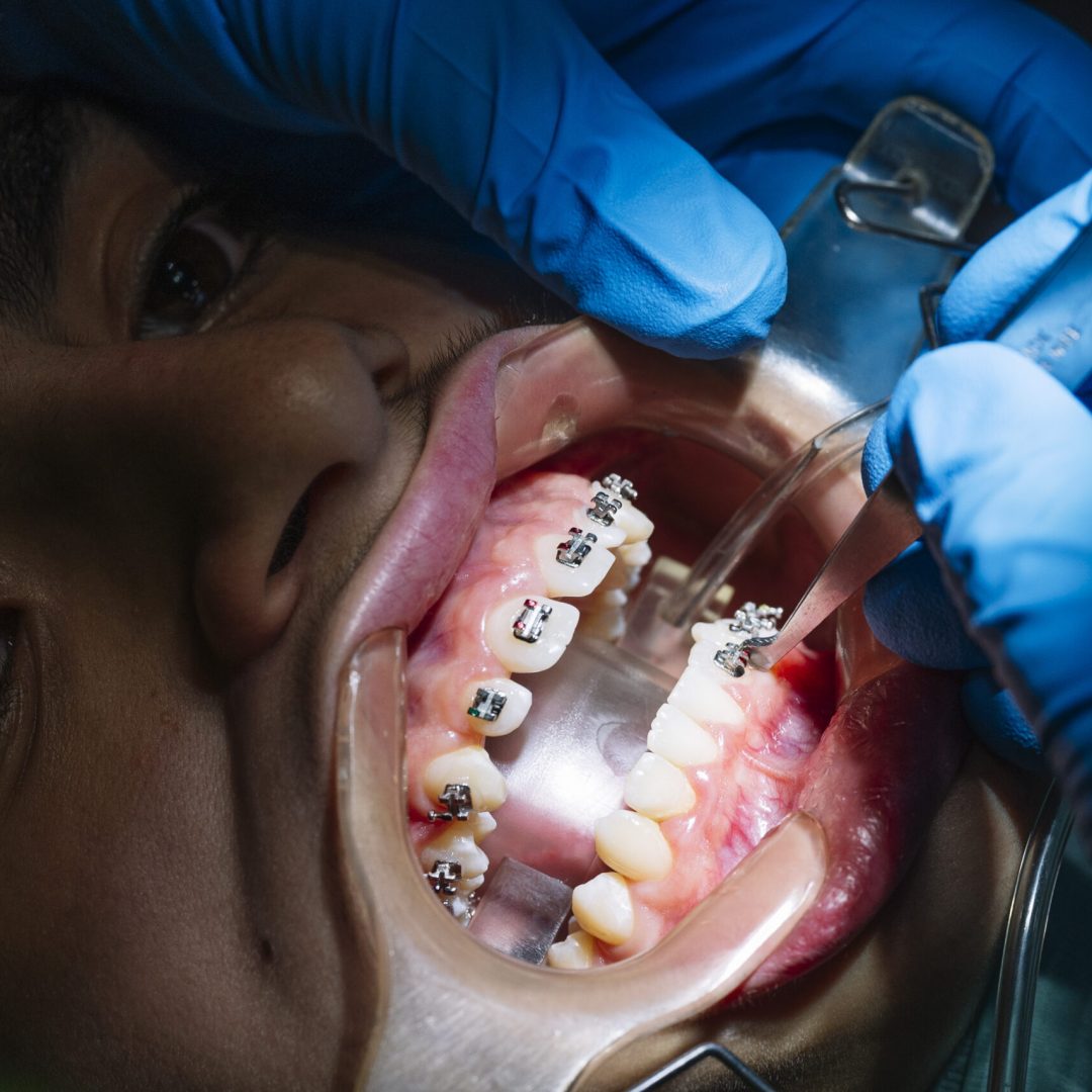 Teenage at the dental clinic putting bracket to correct teeth