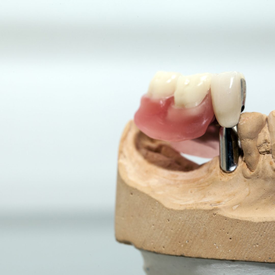 Zirconium Porcelain Tooth plate in Dentist Store Photo